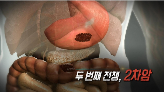 '생로병사의 비밀' 2차암 [KBS]