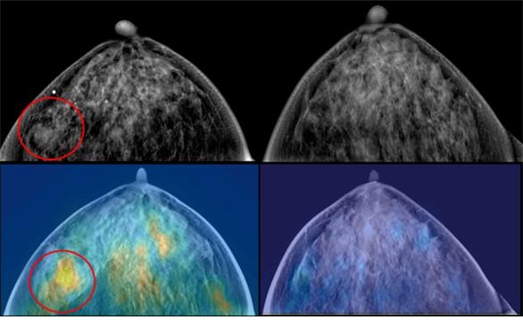 임상 결과, 병변(동그라미)이 X-선 영상(좌측상단)에서는 유방암 여부가 불확실 했으나, 근적외선 영상(좌측하단)을 융합했을 때는 유방암을 확인할 수 있었다. 우측은 정상 유방 소견 [KERI 제공]