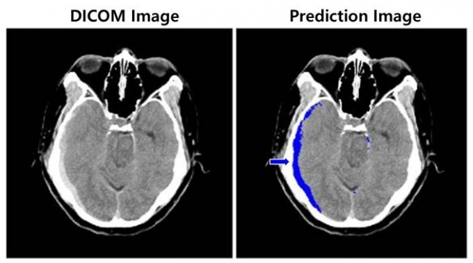 왼쪽은 뇌출혈이 의심되는 환자의 뇌 CT 영상, 오른쪽은 뇌출혈 영상 판독 AI 모델이 출혈 병변(화살표) 존재와 위치를 식별한 영상 [사진=SK(주) C&C]