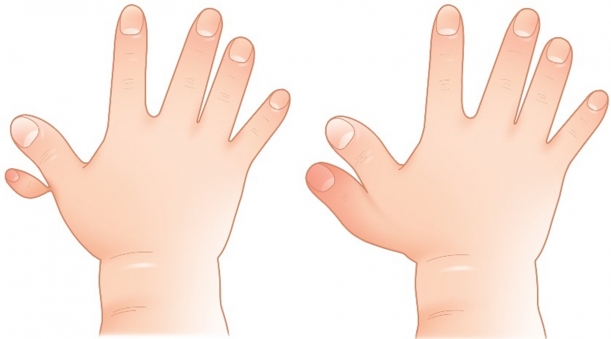 저형성증에 해당하는 엄지손가락 다지증(왼쪽)과 저형성증이 아닌 엄지손가락 다지증. 구분에 따라 수술방법이 달라진다. [사진=서울아산병원]